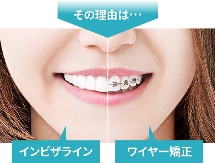 その理由は・・・インビザライン、ワイヤー矯正